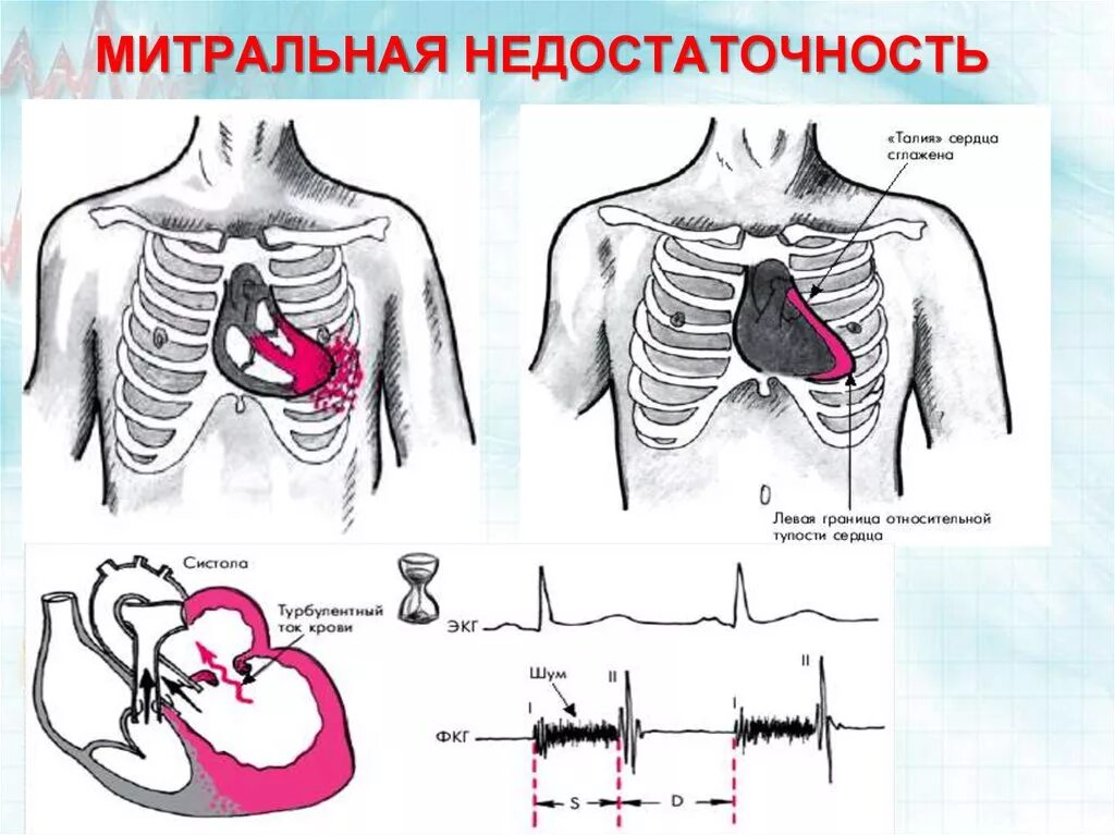 Недостаточность митрального клапана аускультация схема. Недостаточность митрального клапана перкуссия. Митральная недостаточность аускультация. Недостаточность митрального клапана аускультация. Сердечная недостаточность митрального клапана