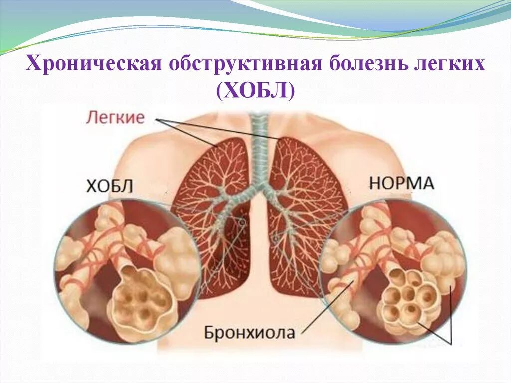 Хроническое обструктивное заболевание. Легкие при ХОБЛ картинки. Хроническая обструктивная болезнь легких.