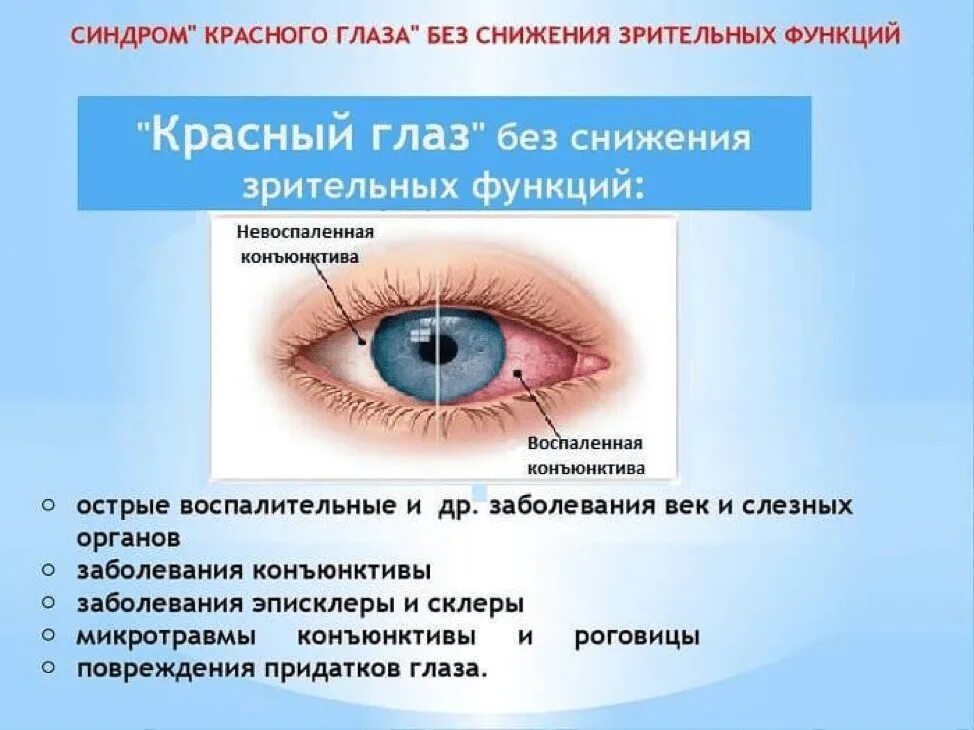 Слезотечение при простуде. Воспаление покраснение глаза. Покраснение глаз и слезотечение. Покраснение глаз причины.