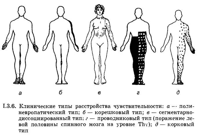 Типы поражения чувствительности. Сегментарно-корешковый Тип расстройства чувствительности. Периферический корешковый Тип нарушения чувствительности. Корковый Тип расстройства чувствительности. Мононевропатический Тип расстройства чувствительности.