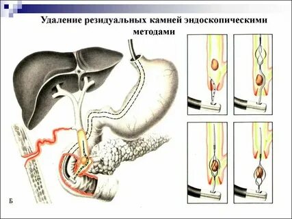 High stone как удалить