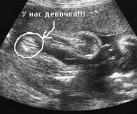 Пол ребенка 30 недель. Узи 26 недель беременности. Пол ребенка 30 недель. Пол ребенка 30 недель. Узи 20 недель беременности мальчик.