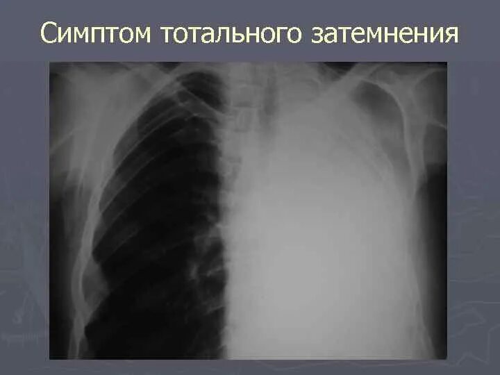 Затемнение в левом легком. Синдром обширного затемнения рентген. Затемнение легочного поля рентген. Субтотальное затемнение легких рентген. Тотальное и субтотальное затемнение легочного поля.