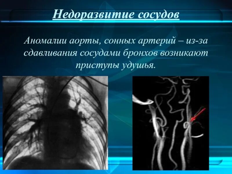 Сосудистая аномалия. Пороки развития дыхательной системы. Аномалии развития сосудов. Врожденная аномалия сосудов.