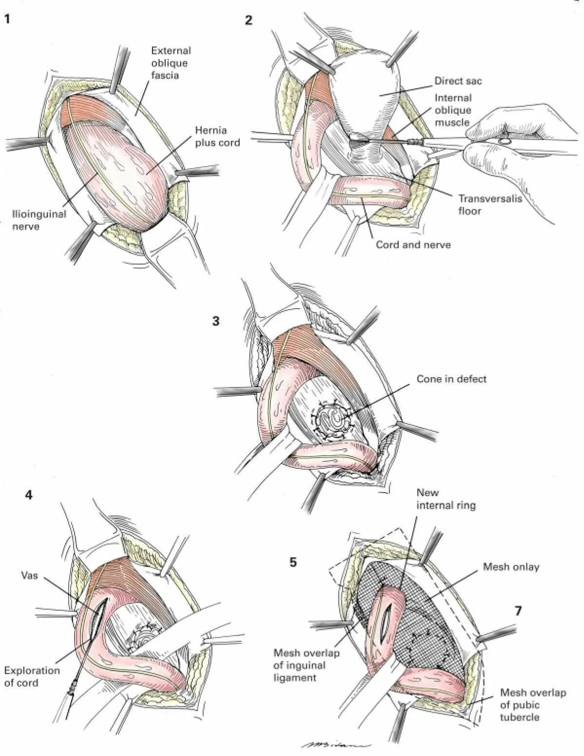 Операция Лихтенштейна при паховой грыже схема. Грыжа семенного канатика. Герниопластика по Лихтенштейну при паховой грыже. Метод Лихтенштейна при пластике паховой грыжи. Лихтенштейн операция грыжа