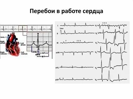 Причины перебоев в сердце у женщины