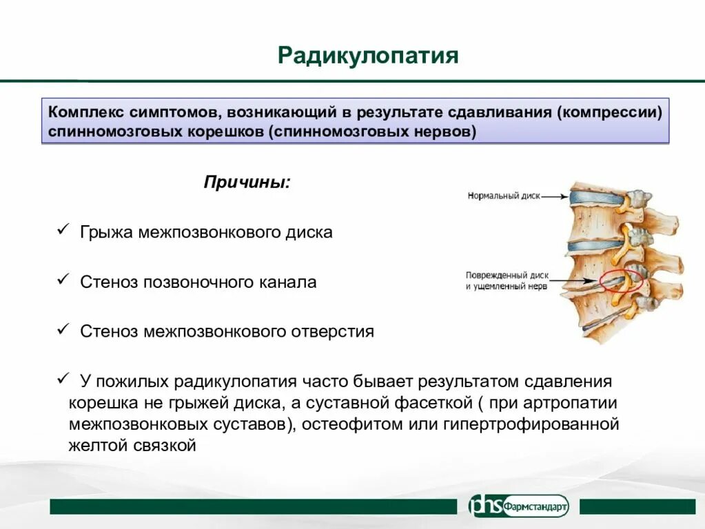 Поясничная радикулопатия лечение. Радикулопатия поясничных Корешков. Радикулопатия Корешков л5. Симптомы дискогенной радикулопатии l4:. Радикулопатия s1 корешка.