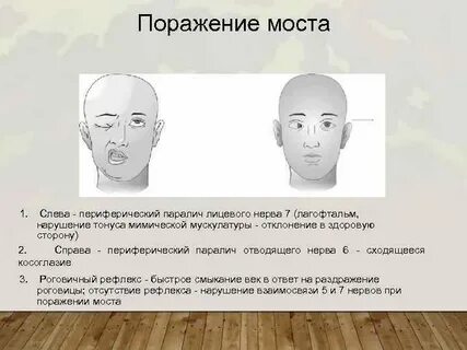 Одностороннее поражение