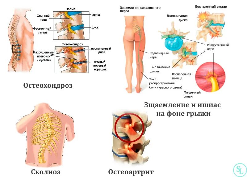 Может ли при грыже быть температура