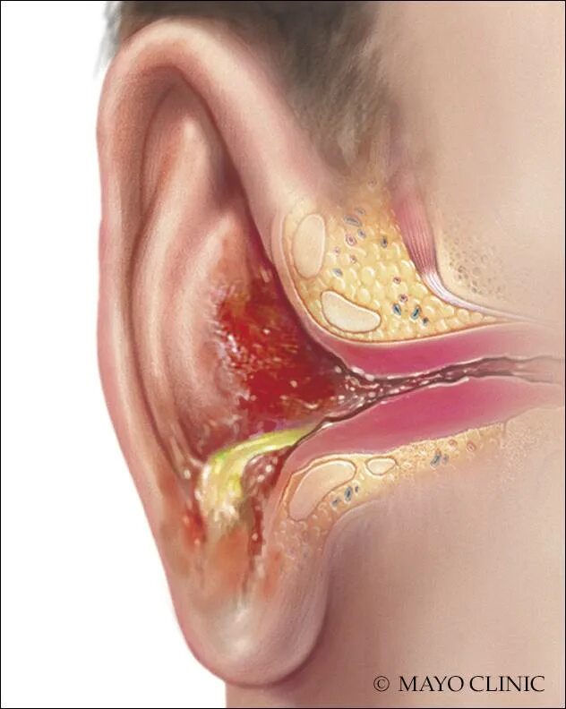 Диффузный наружный отит. Причины воспаления среднего уха
