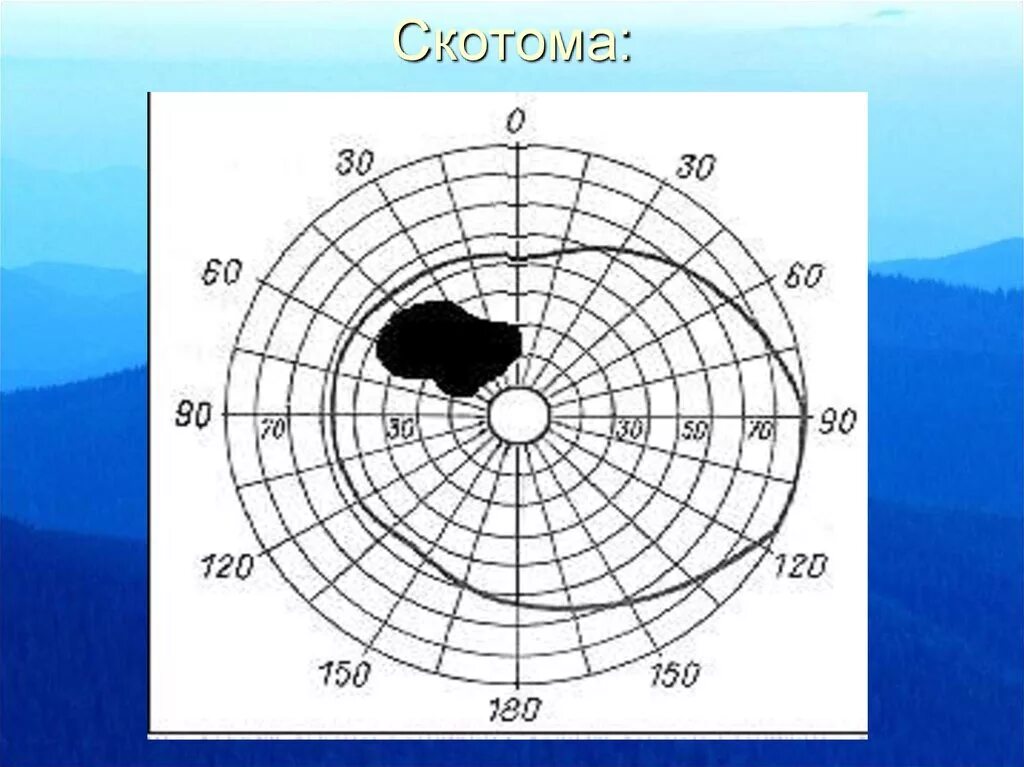 Центральная скотома периметрия. Центральные скотомы в поле зрения. Поля зрения абсолютная скотома. Поле зрения скотома 1.