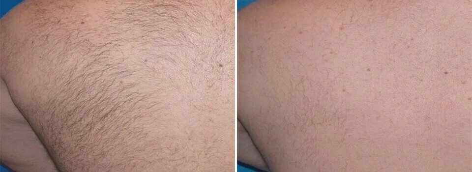 Лазерная эпиляция диодным лазером. Лазерная эпиляция итог. После диодной эпиляции. Диодный лазер для эпиляции до и после. Диодный лазер для эпиляции до и после.