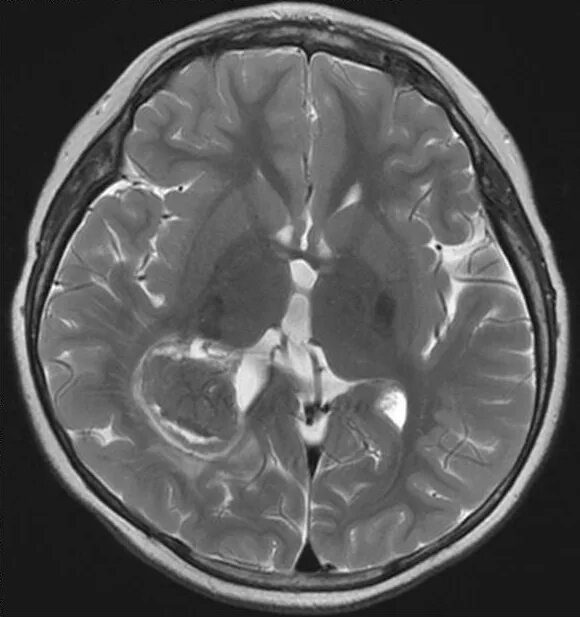 Папиллома хориоидного сплетения. Менингиома левого бокового желудочка. Киста головного мозга причины