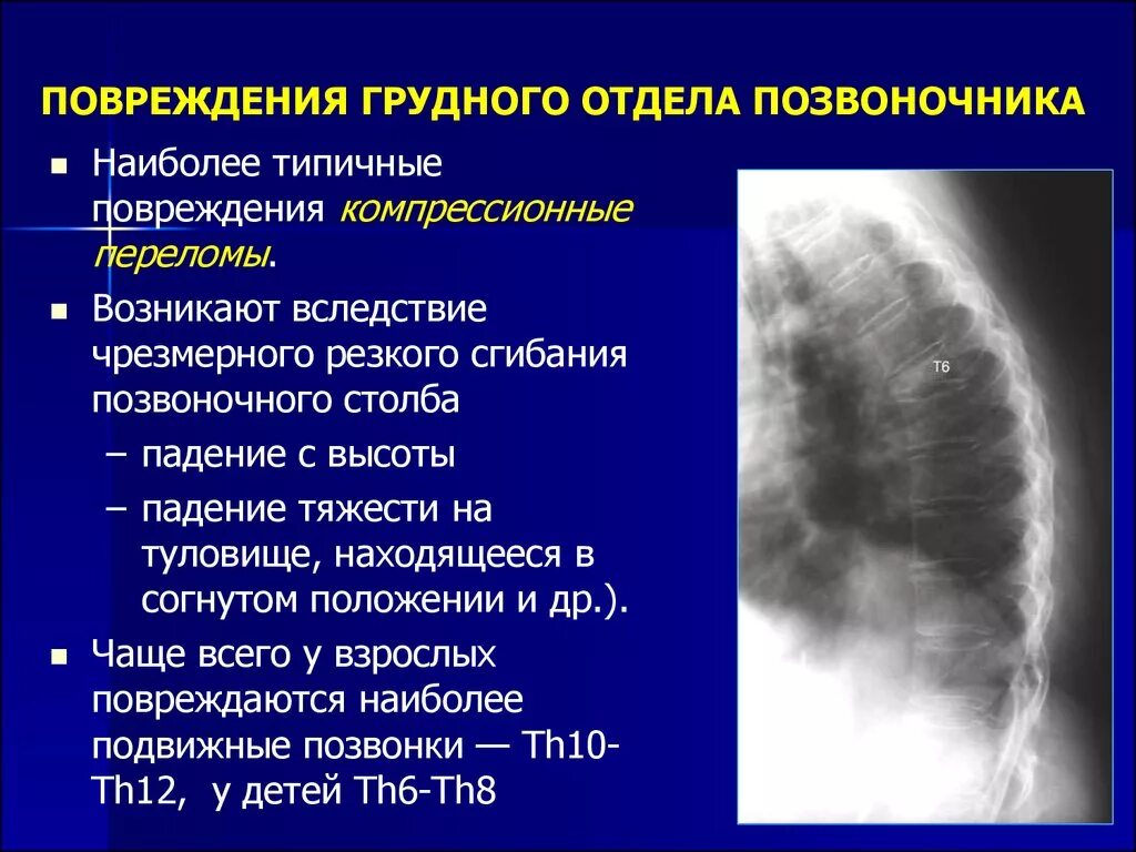 Травмы грудного отдела позвоночника. Ушиб грудного отдела позвоночника. Травмы грудного и поясничного отделов позвоночника. Ушиб грудного позвонка.