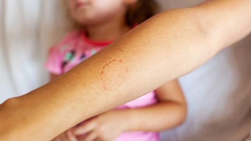 Как выглядит синяк от укуса Nie uwierzysz co doprowadziło tego nastolatka do śmierci! Hickies, Hickeys, Hick