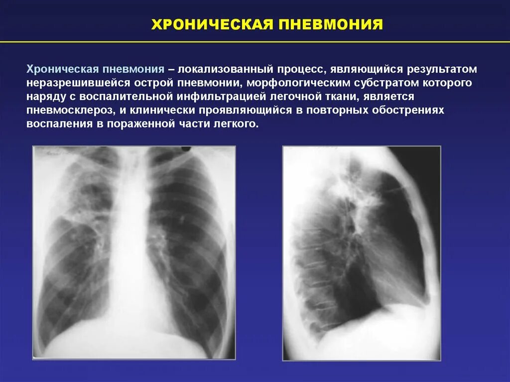 Рентгенологические признаки хронической пневмонии. Хроническая пневмония рентген. Хроническая неспецифическая пневмония. Рентген признаки пневмонии.