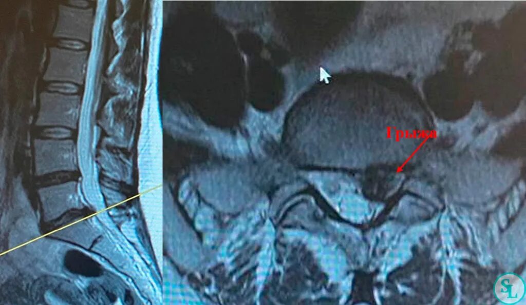 Секвестрированная грыжа l5-s1. Секвестрированная грыжа поясничного отдела l5/s1. Секвестрированная грыжа l5-s1 мрт. Люмбокостальная грыжа.