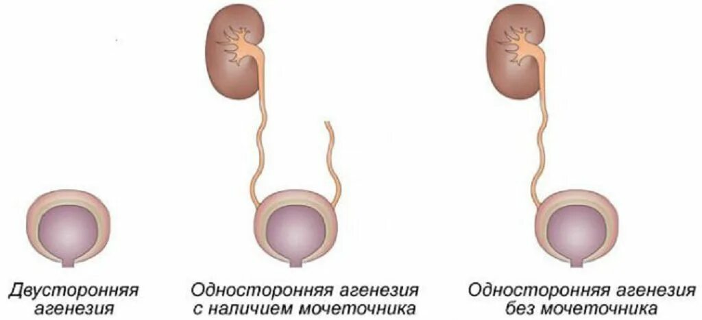 Два мочеточника. Двусторонняя аплазия почек. Односторонняя агенезия почек. Агенезия и аплазия почки.