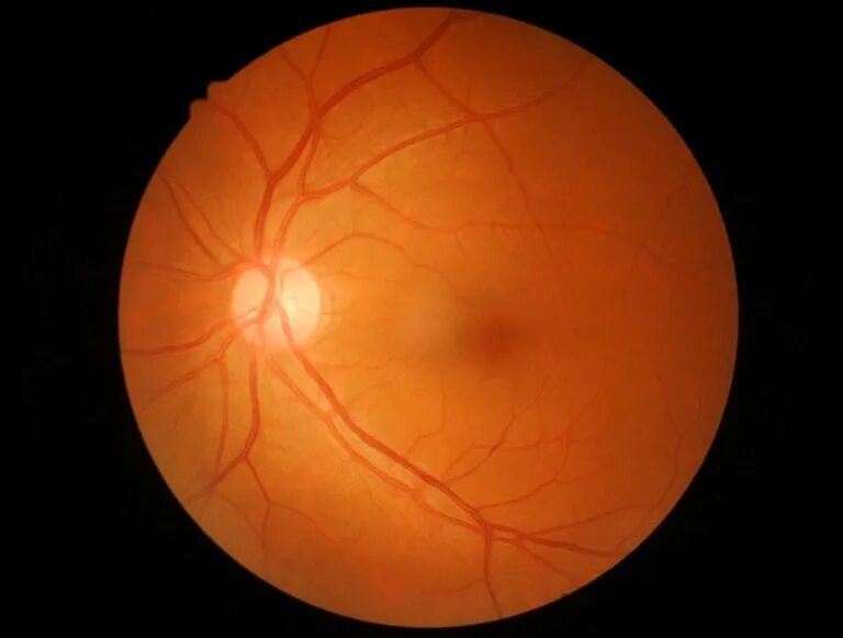Миелиновые волокна ДЗН. Глазное дно миелиновые волокна. Миелиновые волокна зрительного нерва.