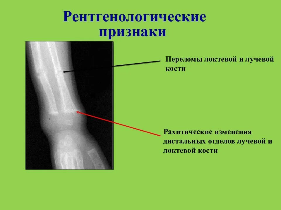 Локтевая кость симптомы