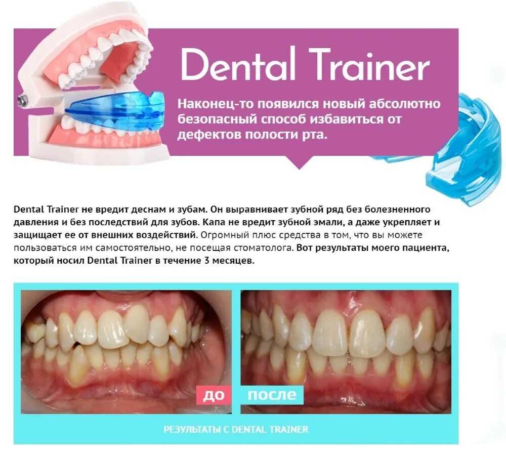 Капы в строительстве. Капа Dental Trainer. Трейнеры для выравнивания зубов. Капы для выравнивания зубов. Трейнер для исправления прикуса.