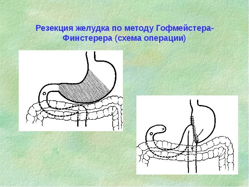 Умер от резекции желудка. Резекция желудка по гофмейстеру-Финстереру. Резекция желудка по Бильрот 2 гофмейстера Финстерера. Резекция желудка по Витебскому схема операции. Резекция 2/3 желудка по гофмейстеру-Финстереру.