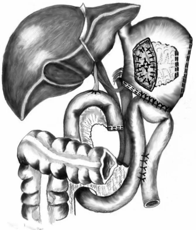 Поджелудочную удаляют полностью. Резекция поджелудочной железы операция. Субтотальная резекция поджелудочной. Билиарнозависимый панкреатит. Очищаем поджелудочную железу.
