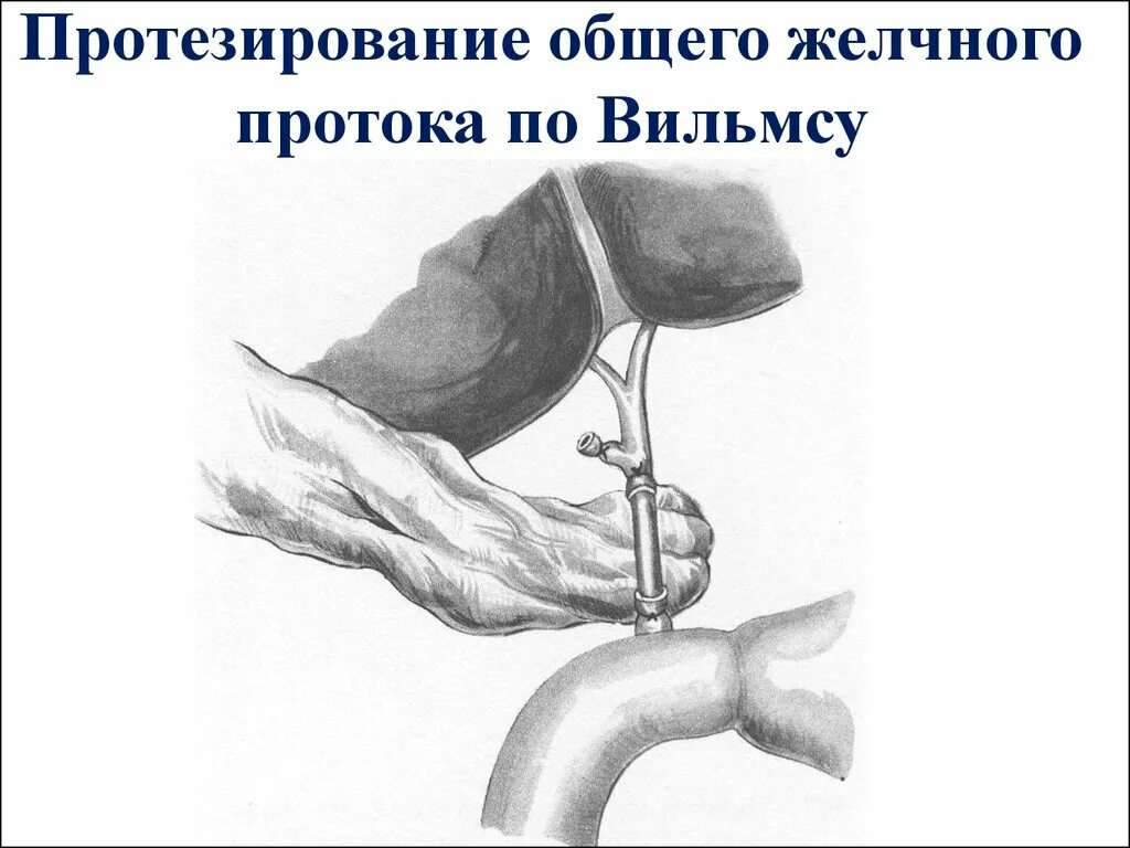 Эндопротезирование желчных протоков. Протезирование общего желчного протока. Бужирование желчного протока. Стент желчного протока