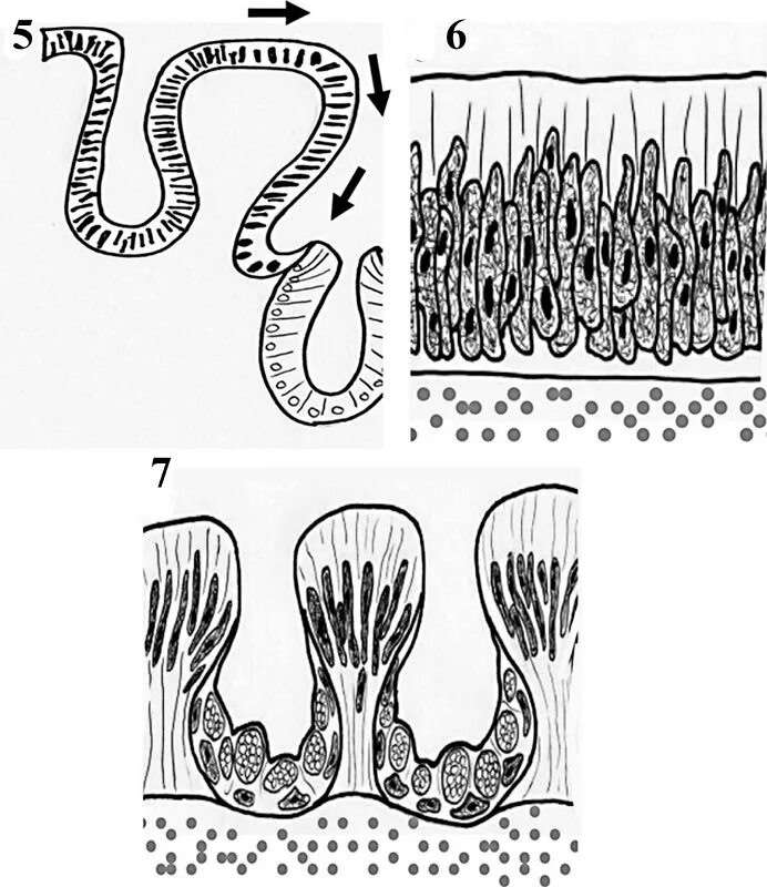 опухоли кишечника классификация. тубулярная аденома толстой кишки гистология. аденома толстой кишки микропрепарат. аденома толстой кишки гистология. тубулярная неоплазия толстой кишки.
