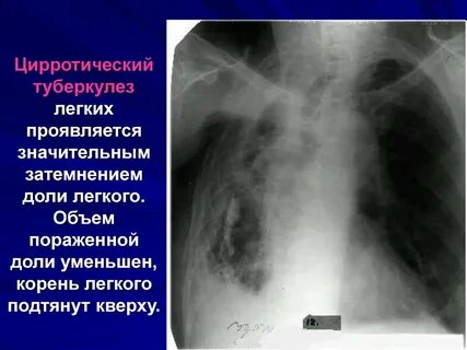 Метатуберкулезное изменение легкого
