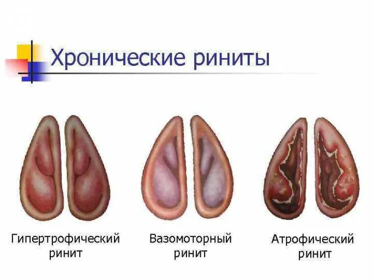 Хронический атрофический ринит риноскопия. Хронический гипертрофический ринит формы. Хронический гипертрофический ринит риноскопия. Хронический вазомоторный ринит риноскопия. Острый катаральный ринит