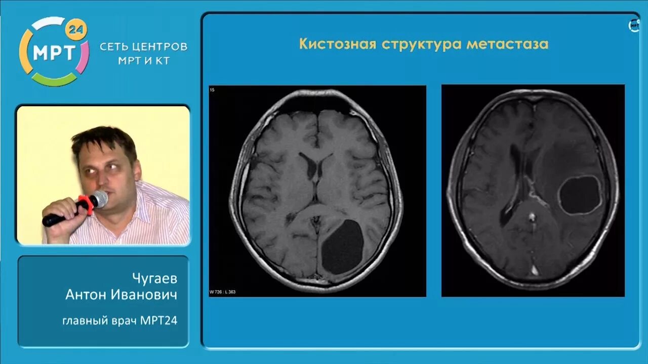 Тяжелое поражение головного мозга. Метастатическое поражение головного мозга. Органическое поражение мозга на мрт. Мрт головного мозга с поражением. Демиелинизирующие заболевания мрт.