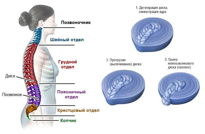 Грыжа позвоночника экструзия диска. Пролапс межпозвоночного диска шейного отдела. Пролапс протрузия позвоночника. Пролабирование межпозвоночного диска. Экструзия дисков шейного отдела позвоночника