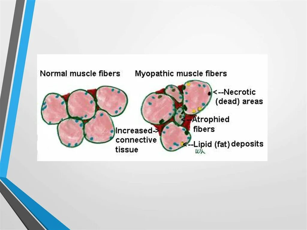 Стероидная миопатия. Миопатия патогенез. Миопатия Дюшенна патогенез. Миопатия с диспропорцией типов мышечных волокон.