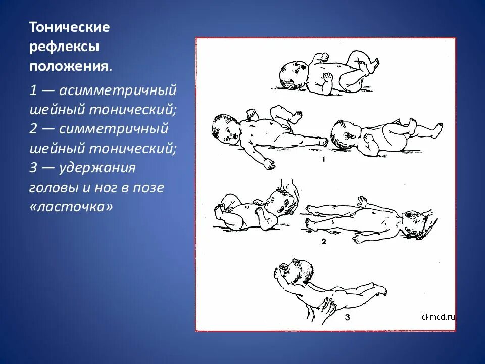 Шейный рефлекс. Ассиметричный шейно-тонический рефлекс. асимметричный лабиринтный тонический рефлекс. аштр – ассиметричный шейный тонический рефлекс. шейно тонический рефлекс новорожденных.
