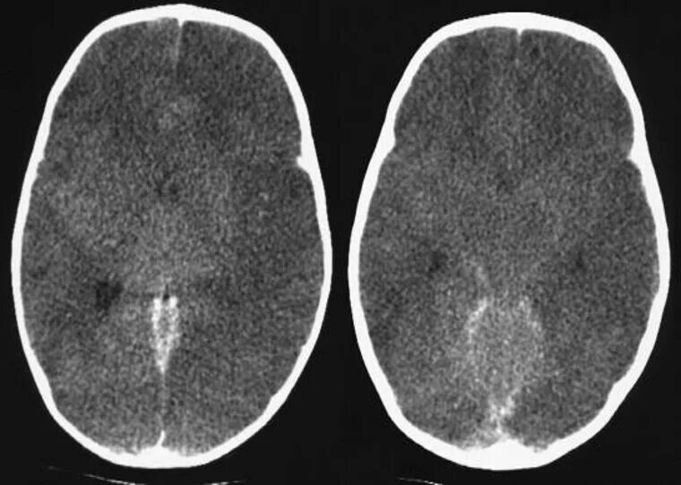 Вазогенный отек головного мозга кт. Цитотоксический отек головного мозга кт. Отек головного мозга на кт признаки.