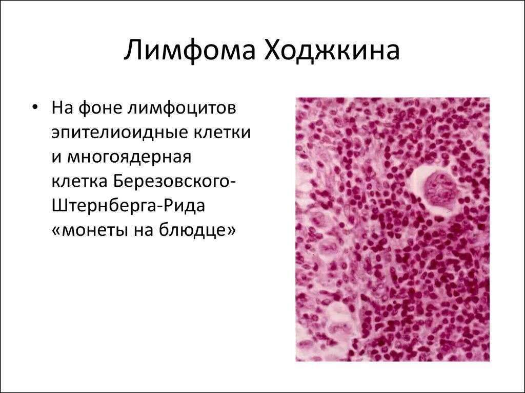 Неходжкинская лимфома гистология. Неходжкинская лимфома микропрепарат. Лимфома гистология лимфоузла. Ходжкинская лимфома микропрепарат. Лимфоидная опухоль