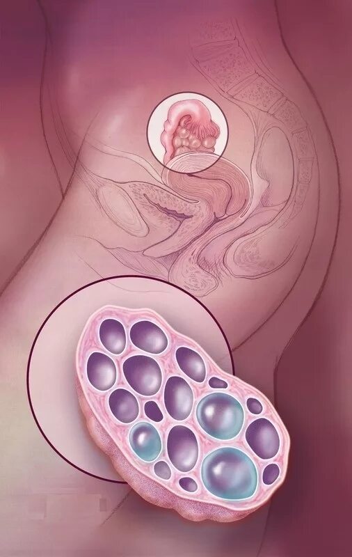 При поликистозе можно забеременеть. Мультифолликулярный поликистоз. Мультифолликулярные поликистоз яичников. Мультифолликулярный поликистоз яичников. Мультифолликулярные кисты яичников.