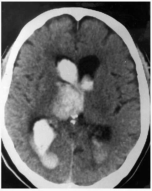 Внутримозговая гематома кт. Кт внутримозговое кровоизлияние мозолистого тела. Геморрагический инсульт с прорывом в желудочки кт. Кровоизлияние в желудочки мозга кт. Кровоизлияние в желудочки