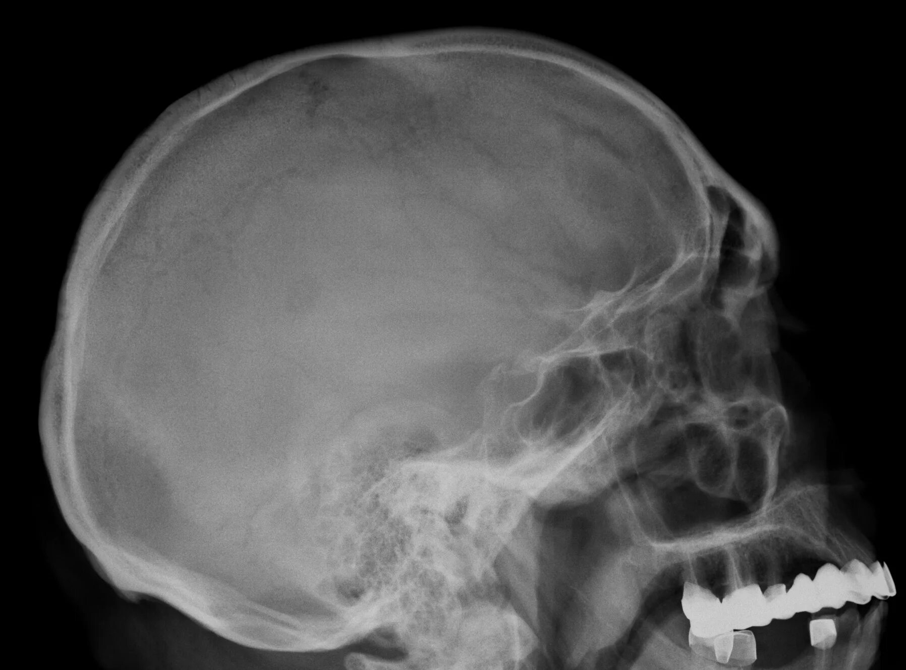 Трещина в голове. Перелом теменной кости черепа рентген. Перелом теменной кости рентген. Рентген черепа субдуральная гематома.