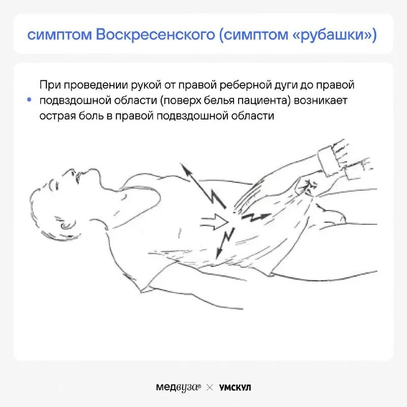 На каком боку лежать при аппендиците. На каком боку лежать при аппендиците. : ровзинга, ситковского, михельсона. Симптом ситковского острого аппендицита. Симптомы воскресенского щеткина-блюмберга ровзинга ситковского.
