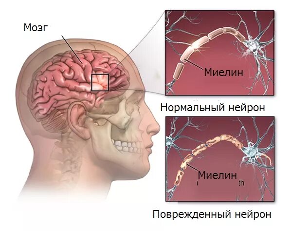 Склероз мозга. Рассеянный склероз мозг. Мозг с рассеянным склерозом. Мозг человека с рассеянным склерозом. Рассеянный склероз Макропрепараты.