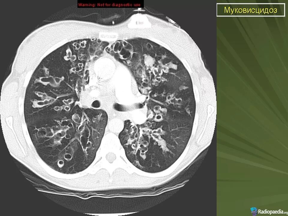 Дерева в почках в легких кт. Муковисцидоз на кт легких. Бронхоэктазы на кт. Муковисцидоз поджелудочной железы кт.