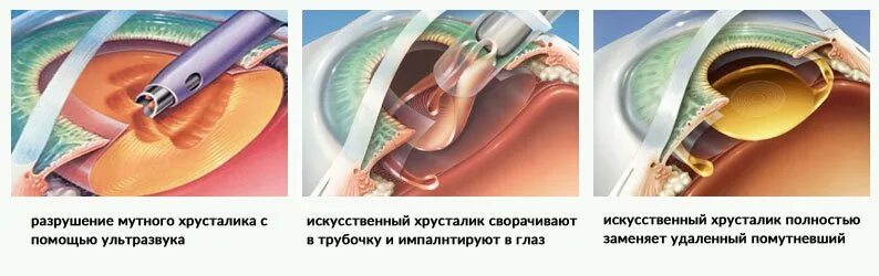 Катаракта после операции можно работать. Факоэмульсификация катаракты этапы операции. операция на хрусталик глаза. разрушение хрусталика. как проводят операцию по замене хрусталика глаза.