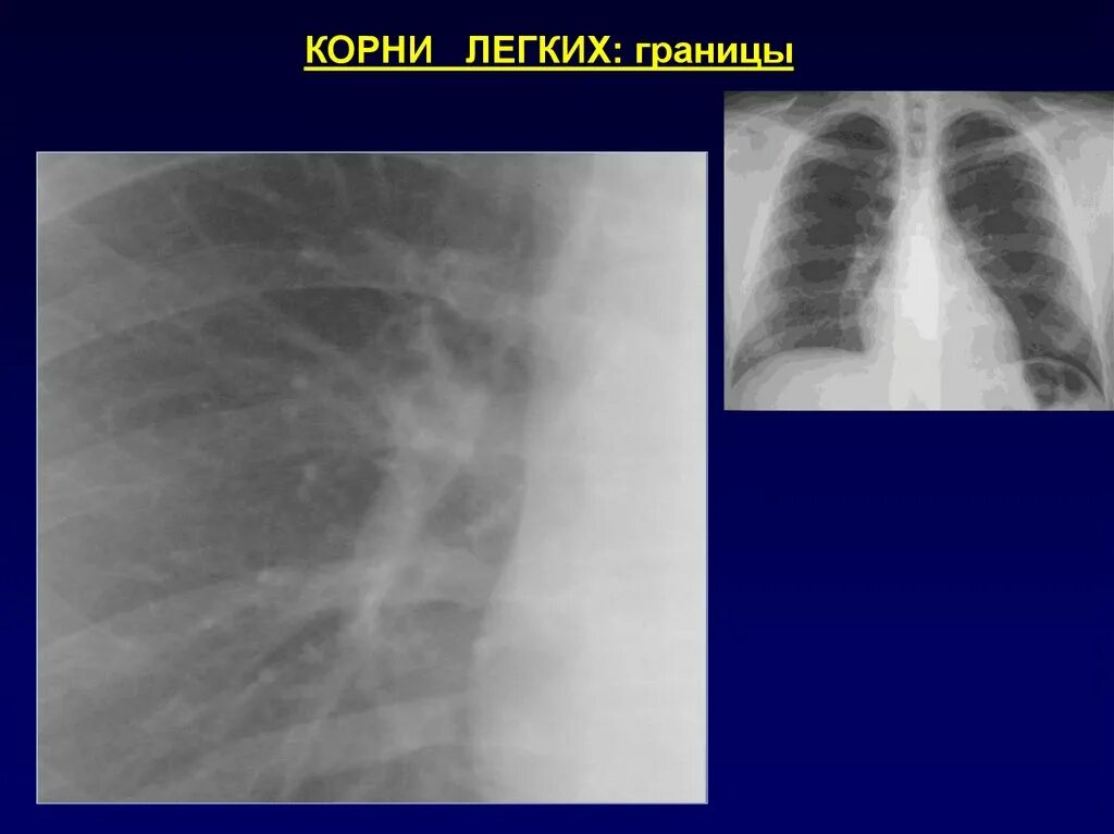 Рентген уплотнение корня лёгкого. Патология корня легкого рентген. Патология корня легкого на рентгенограмме. Корень легкого на рентгенограмме в норме. Корень легкого уплотнен что значит