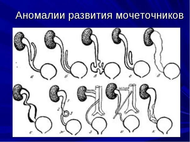 Развитие мочеточников. Пороки развития почек и мочеточников. Врожденная аномалия развития мочеточников. Аномалии формы мочеточника. Врожденные аномалии мочеточников классификация.