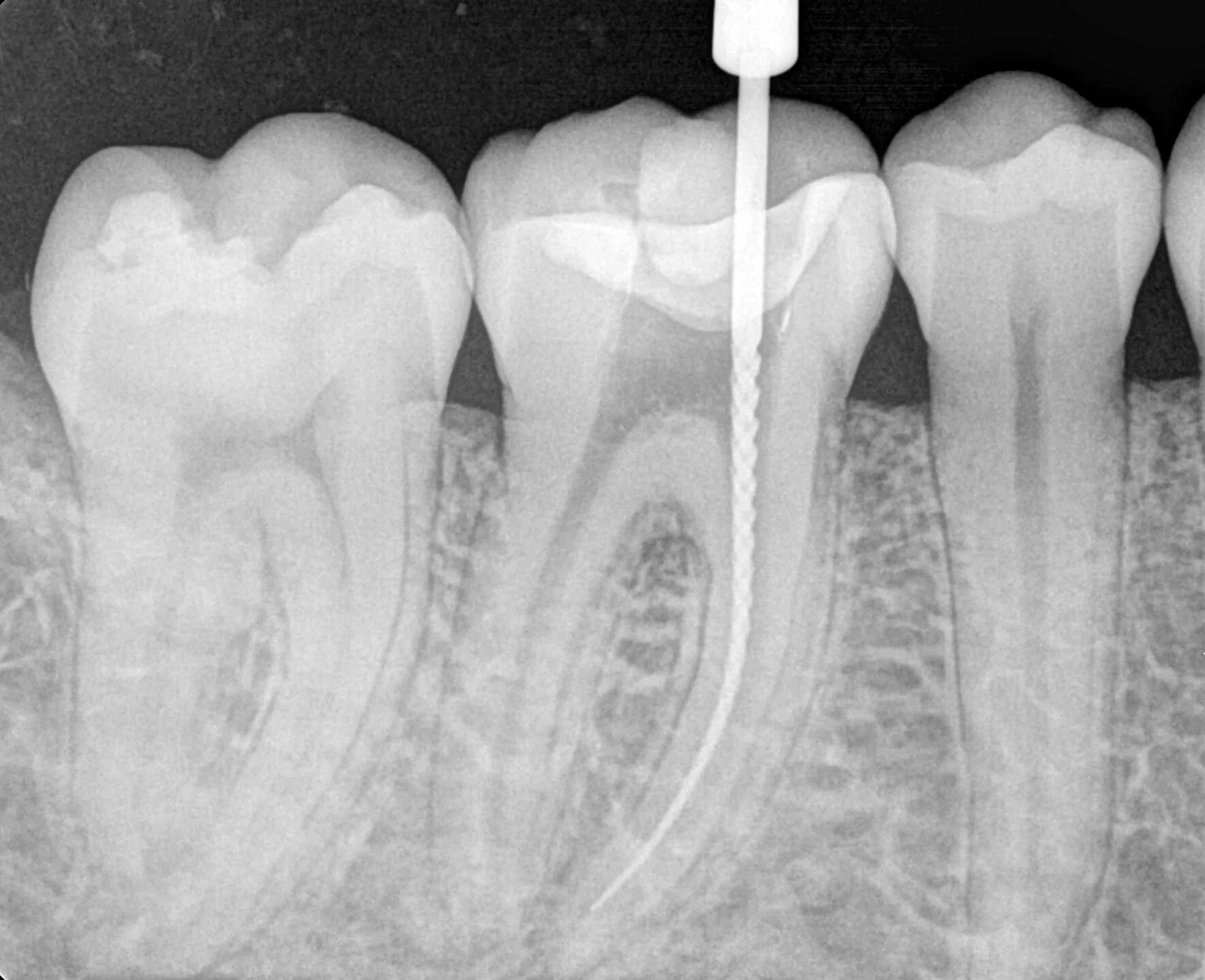4 Канальный пульпит зуба. Запломбированные корневые каналы.