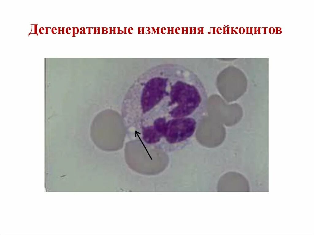 Дегенеративные изменения лейкоцитов. Дегенеративные изменения Лейко. Дегенеративно измененные лейкоциты.. КДЗ дегенеративных изменений лейкоцитов. Изменения лейкоцитов в крови