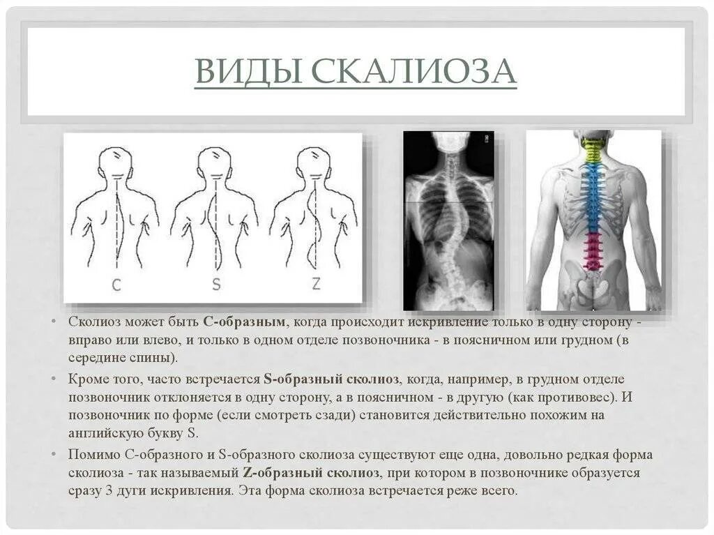 Локальный статус позвоночник. Лекарство при искривлении позвоночника сколиоза 1 степени. Сколиоз позвоночника s образный грудного. ЛФК сколиоз 3 степени s образный. Z- образный сколиоз (с тремя дугами искривления);.