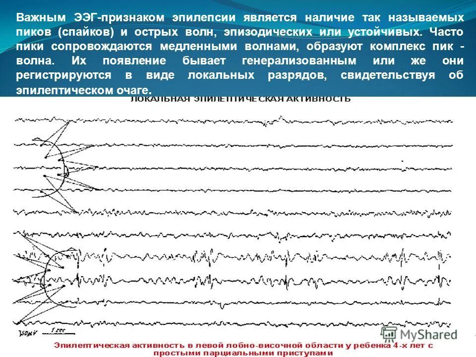 Ээг при эпилепсии. Комплексы пик волна на ээг. ээг комплексы «пик — медленная волна»,. ээг норма и эпилепсия. ээг при эпилепсии расшифровка с записью.